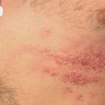 Herpes zoster tratament zona zoster