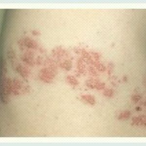 Herpes zoster tratament zona zoster