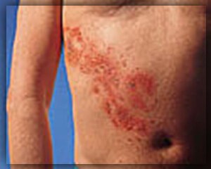 Herpes zoster tratament zona zoster