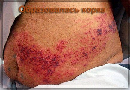 Herpes zoster tratament zona zoster