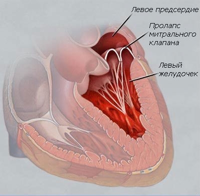 Prolapsul inima care este