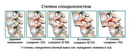 Cum de a reduce o vertebră