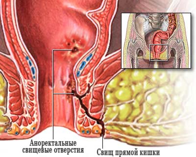 Fistula - Cauze fistulă - simptomele fistulei - diagnosticul de fistula