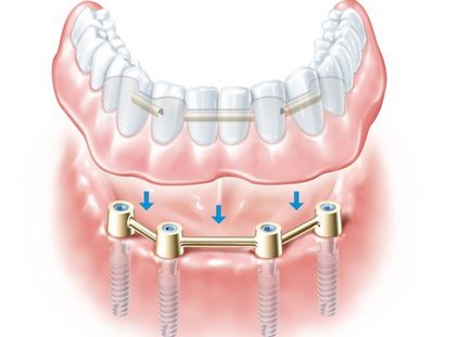 Instalarea de implanturi - etapele de montaj și prețul de implanturi dentare - portal stomatologic