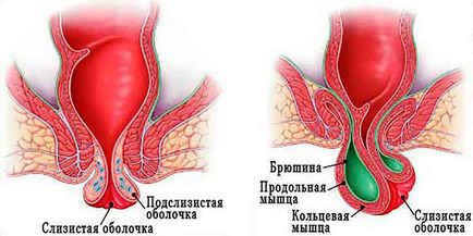 Rectala prolaps-l