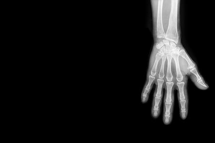 Ce se poate face în cazul în care un deget dislocat