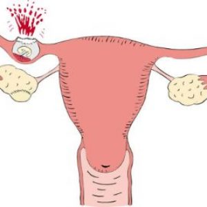 Cum și când apare o sarcina extrauterina
