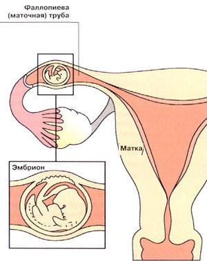 Cum și când apare o sarcina extrauterina