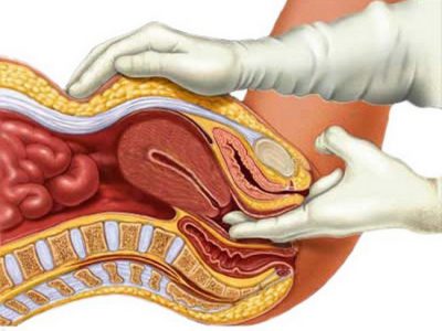 Tratamentul fanere uterine și