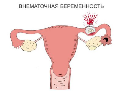 Tratamentul fanere uterine și