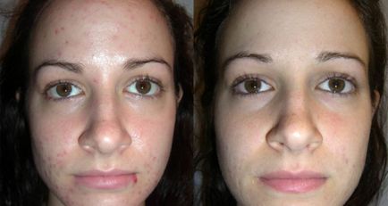 Peeling comentarii ale pielii Peeling comentarii ale pielii