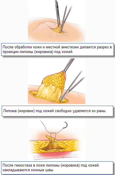 Ce este sub piele