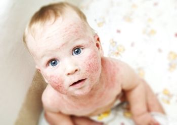 erupții alergice la copii arata ca in fotografie, diferite tipuri de alergii pe piele, simptome și tratament