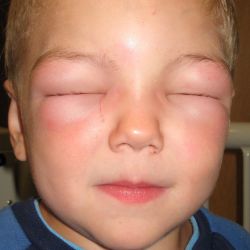 Alergice provoacă umflarea feței, prim ajutor și tratament