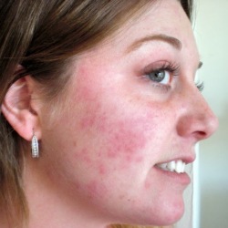 Alergice provoacă umflarea feței, prim ajutor și tratament