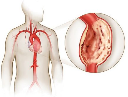 anevrism septal atrial sau MPP anevrism - care este la adulți