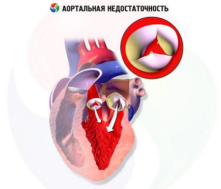 Cauzele aortic regurgitare, simptome, diagnostic, tratament, competente pentru sanatate pe ilive