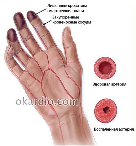 Buerger simptomele bolii si de tratament, cauze, tipuri și diagnosticarea bolii