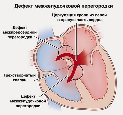 inima mare cauze, diagnostic, tratament și prognosticul bolii