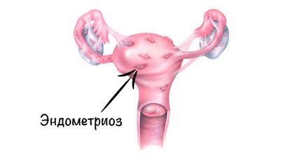 Endometrioză periculoase 2