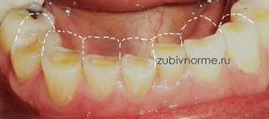 Ce este cauzele bruxism, simptome, tratament, paza bruxism gura atunci când