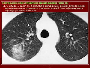 Care este infiltrarea semnelor de țesut pulmonar și simptome de infiltrare în plămân