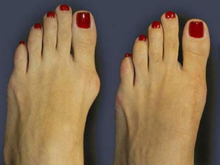 Deformarea degetelor de la picioare ca un fix - valgus degetului mare, și nu știai