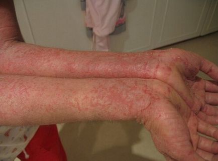 Dermatozele - forme, cauze, simptome (foto), tratament