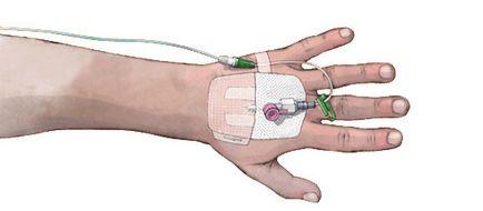 Flebită (inflamație a venelor) mâinilor și a membrelor inferioare simptome, tratament