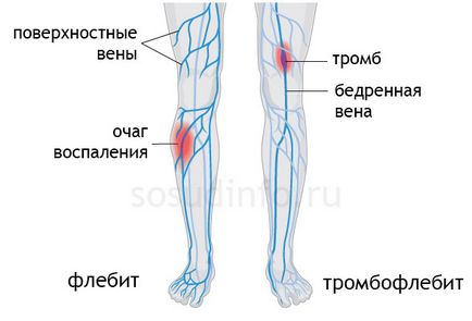 Flebită (inflamație a venelor) mâinilor și a membrelor inferioare simptome, tratament