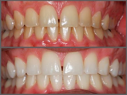 fotooxidare dinți care este, înainte și după fotografii, marturii