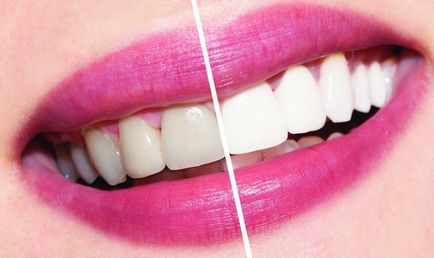 fotooxidare dinți - procesul procedurii, contraindicațiile și rezultatul pentru pacient