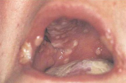 simptome infecție cu herpes, tratament, complicații
