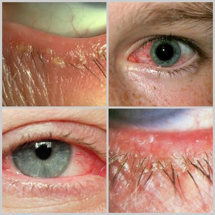 Eye tratament acarianul la oameni, simptome, fotografii