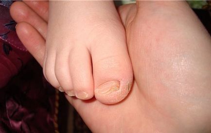 Mucegaiuri pe picioarele o fotografie a copilului decât pentru a trata picior și unghiile