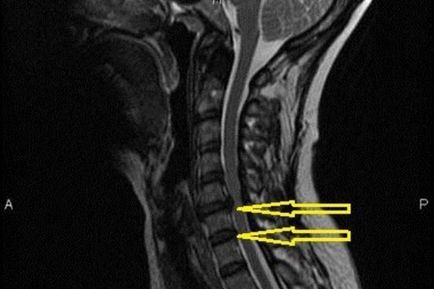 Herniate simptomele coloanei cervicale si tratamente, gimnastica