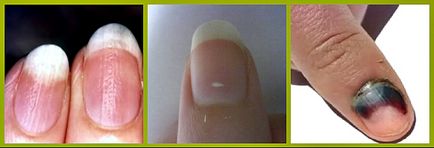 Modificări ale unghiilor - semnalează despre starea de sanatate a organismului