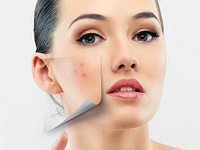 Cum să scapi de acnee pe fata ta la domiciliu - remedii pentru acnee, masca, cauzele