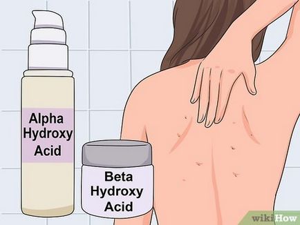 Cum să scapi de acnee pe spate