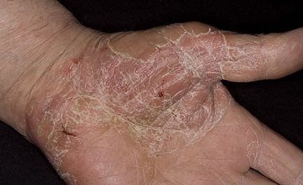 Cum de a vindeca remedii populare eczeme