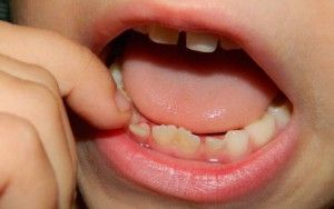 Cum de a smulge copilul dinte într-un copil la domiciliu, fără durere
