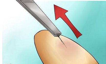 Cum de a scoate paiul din degetul, chiar dacă este profund