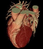 Tomografia computerizata (CT) scanare a inimii și a vaselor de sange - un cardiolog - site-ul de boli ale inimii si vaselor de sange