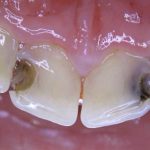 Tratamentul cariilor dentare la adulți, cauzele și simptomele apariției sale