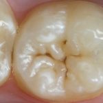 Tratamentul cariilor dentare la adulți, cauzele și simptomele apariției sale