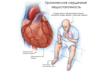 Tratamentul de dispnee în insuficiența cardiacă îndepărtarea simptom și ce medicamente pentru a lua