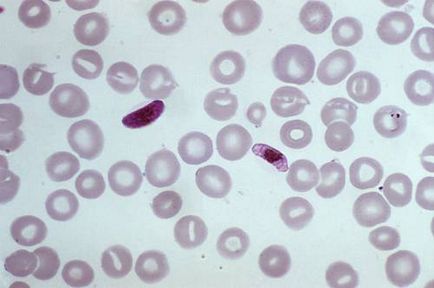 Meningita este contagioasă sau nu, cum pot fi infectate