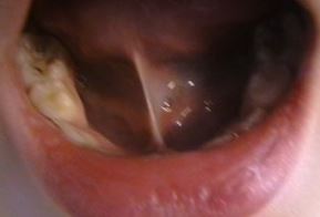 Miogimnastika în ortodonție