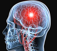 Tratament de hemoragie cerebrală, simptomele de accident vascular cerebral și comă atunci când dieta - enciclopedia ta medicală