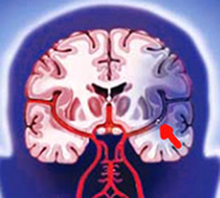 Tratament de hemoragie cerebrală, simptomele de accident vascular cerebral și comă atunci când dieta - enciclopedia ta medicală